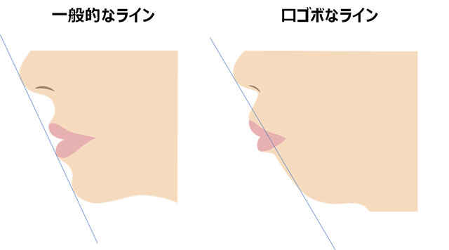 口ゴボのラインイメージ