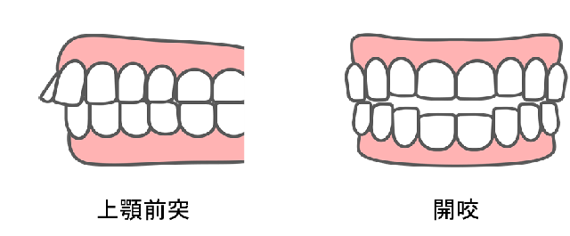 上下の前歯の矯正により口臭は軽減できるのイメージ