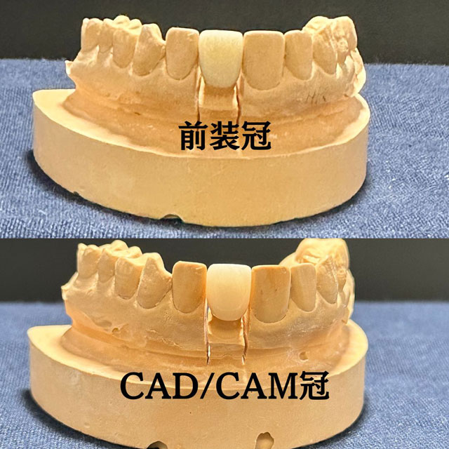 前装冠とCAD/CAM冠の比較