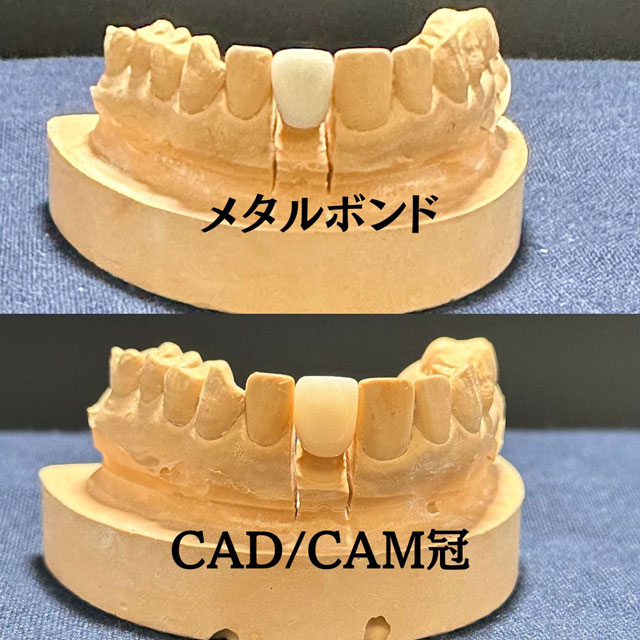 CAD/CAM冠とメタルボンドの比較