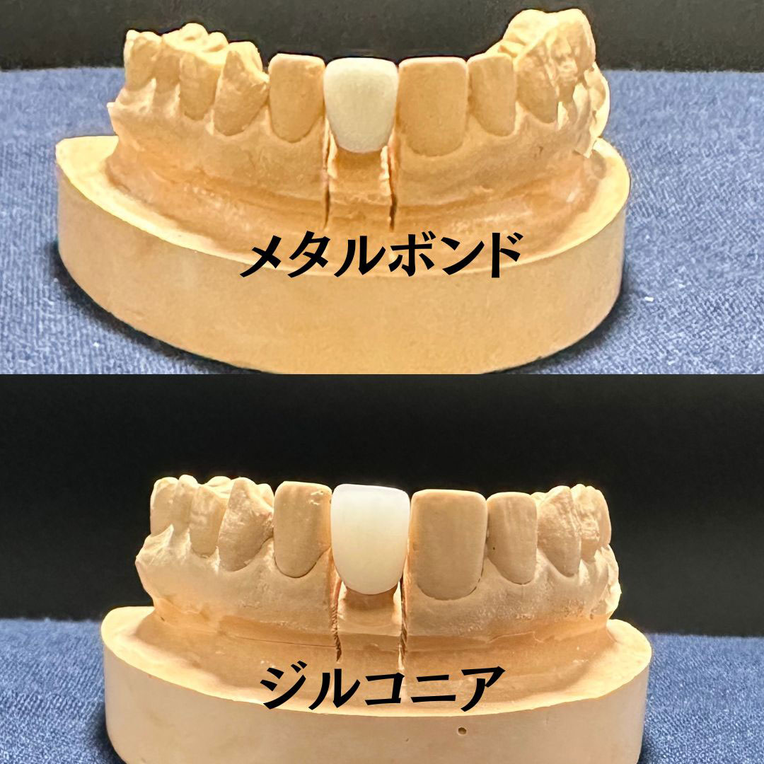 メタルボンドとジルコニアの比較