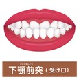 上の前歯より下の前歯が前に出ている（反対咬合）イメージ