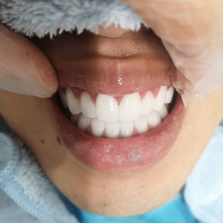 上下本今クリアートダイヤモンドセラミック ダイヤモンド今井デンタルクリニック