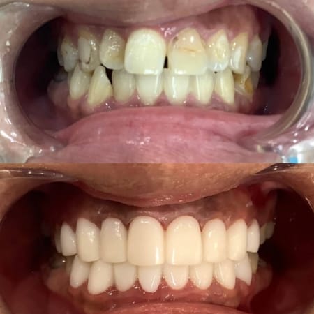 上下16本 仮歯 今クリアートダイヤモンドセラミック ダイヤモンド今井デンタルクリニック