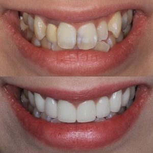  上８本　今クリアートダイヤモンドセラミックの症例