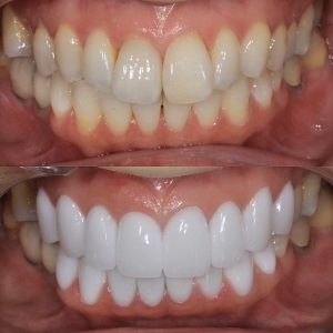  上下16本　今クリアートダイヤモンドセラックの症例