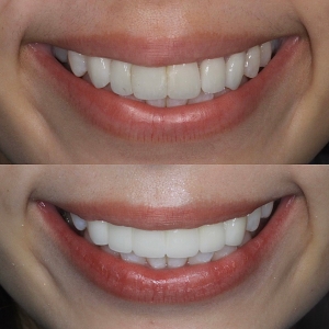  上6本　今クリアートダイヤモンドセラックの症例