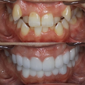  上下20本　今クリアートダイヤモンドセラックの症例
