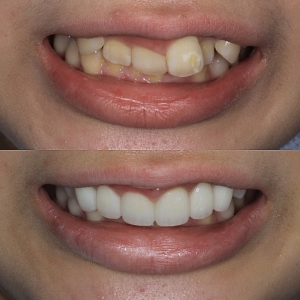  上6本　今クリアートダイヤモンドセラックの症例