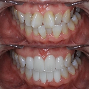  上下8本　今クリアートダイヤモンドセラックの症例