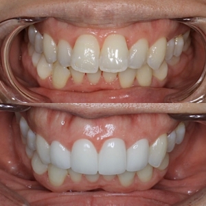  上４本　今クリアートダイヤモンドセラミックの症例