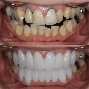  上下１６本　今クリアートダイヤモンドセラミックの症例