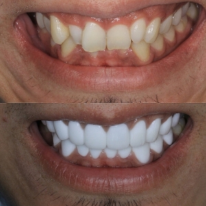  上下20本　今クリアートダイヤモンドセラックの症例