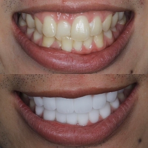  上下16本　今クリアートダイヤモンドセラックの症例