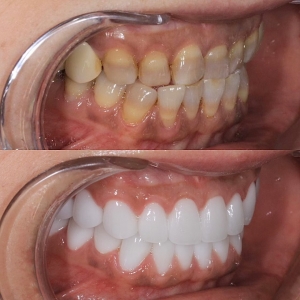  上下27本 今クリアートダイヤモンドセラックの症例