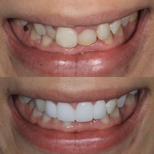  上4本　今クリアートダイヤモンドセラックの症例