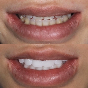  上下14本　今クリアートダイヤモンドセラミックの症例