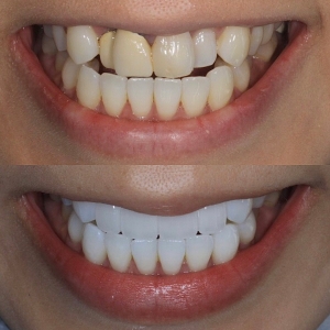  上4本　今クリアートダイヤモンドセラックの症例