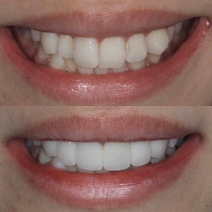  上4本　今クリアートダイヤモンドセラミックの症例