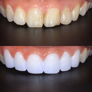  上6本　今クリアートダイヤモンドセラミックの症例