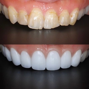  上下17本　今クリアートダイヤモンドセラックの症例