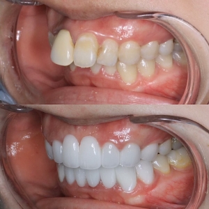  上下16本　今クリアートダイヤモンドセラミックの症例