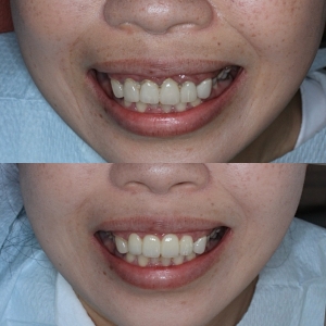  上4本　オールジルコニアの症例