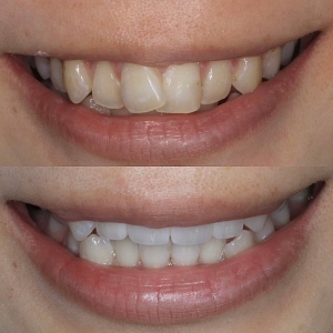  上4本　今クリアートダイヤモンドセラックの症例