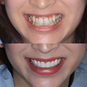  上8本 今クリアートダイヤモンドセラミックの症例