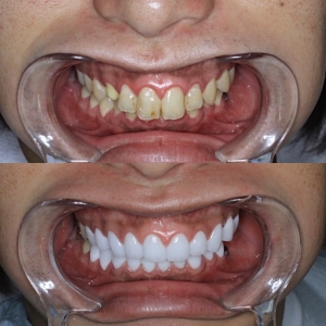  上下20本　今クリアートダイヤモンドセラックの症例