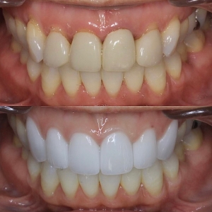  上6本 今クリアートダイヤモンドセラックの症例