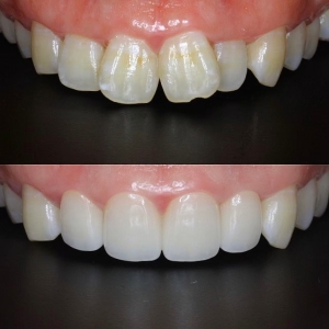  上4本　今クリアートダイヤモンドセラックの症例