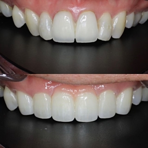  上7本　オールジルコニアの症例