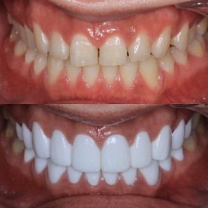  上下20本　今クリアートダイヤモンドセラックの症例