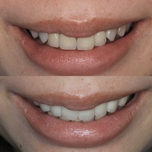  上8本　今クリアートダイヤモンドセラックの症例