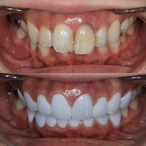  上下16本　今クリアートダイヤモンドセラックの症例