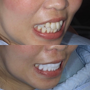  上下16本 今クリアートダイヤモンドセラミックの症例