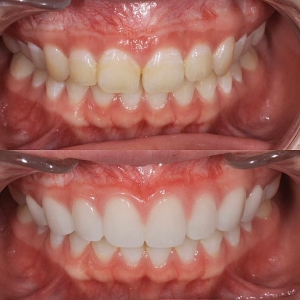  上8本　今クリアートダイヤモンドセラミックの症例
