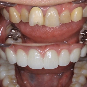  上10本 今クリアートダイヤモンドセラミックの症例