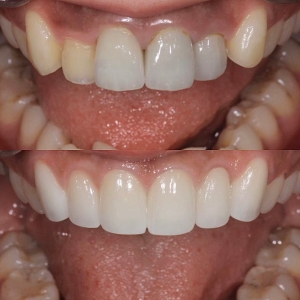  上6本　今クリアートダイヤモンドセラックの症例