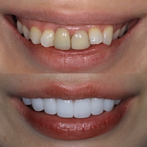  上下16本　今クリアートダイヤモンドセラックの症例