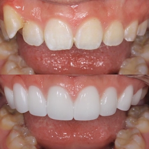  上下16本　今クリアートダイヤモンドセラミックの症例