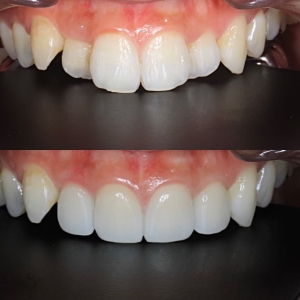  上4本　今クリアートダイヤモンドセラックの症例