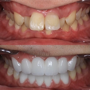  上下12本　今クリアートダイヤモンドセラックの症例