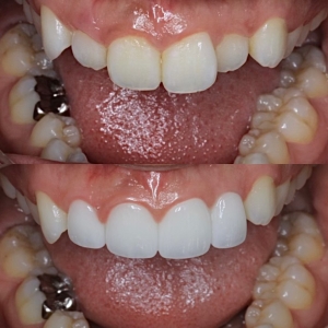  上下10本 今クリアートダイヤモンドセラックの症例