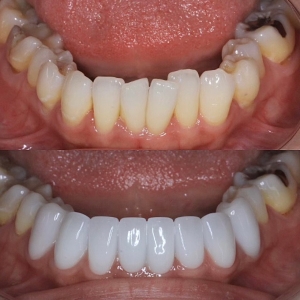  上下14本 今クリアートダイヤモンドセラックの症例