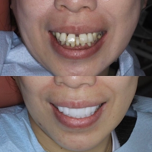  上下16本 今クリアートダイヤモンドセラックの症例