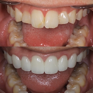  上下16本 今クリアートダイヤモンドセラミックの症例