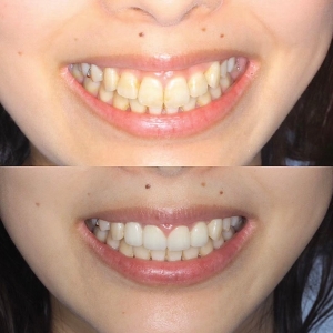  上4本 オールジルコニアの症例