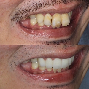  上6本 オールジルコニアの症例